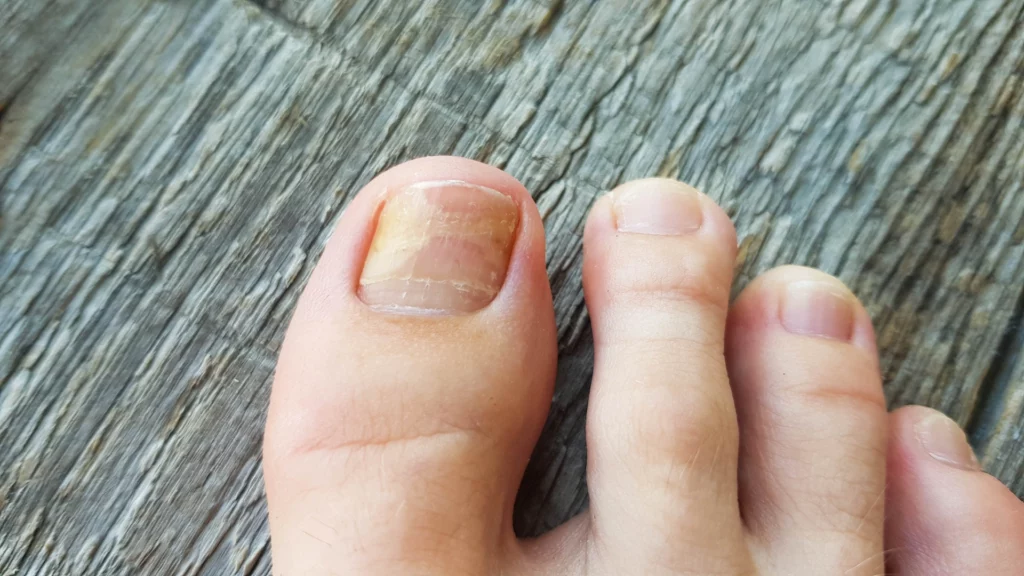 Fungal nail infection - NHS