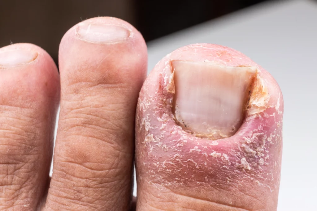 Ingrown toenail non-invasive treatment - The Foot Group