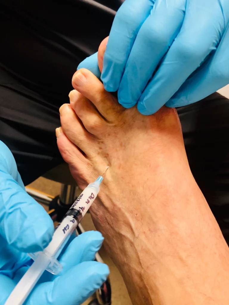 Professional Morton's Neuroma treatment | MyFootMedic