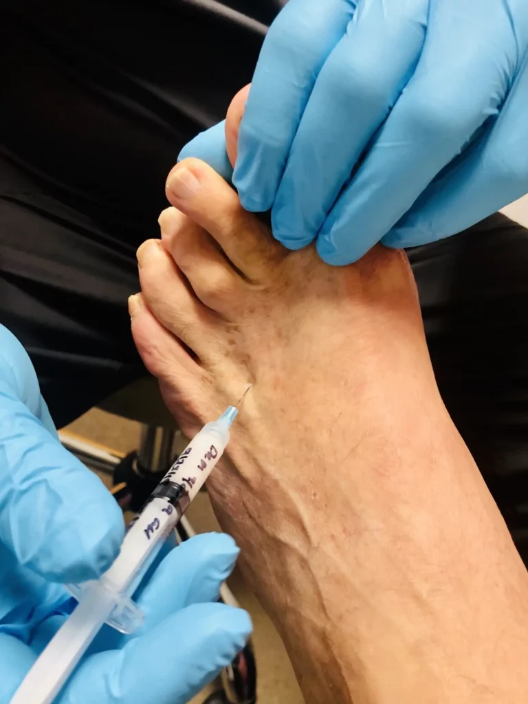 patient getting a steroid injection in his foot 2022 11 08 09 06 53 utc